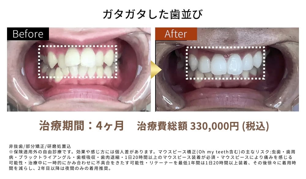 ガタガタした歯並び