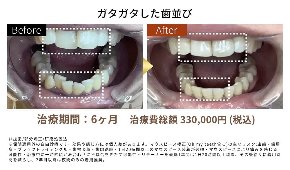 ガタガタした歯並び