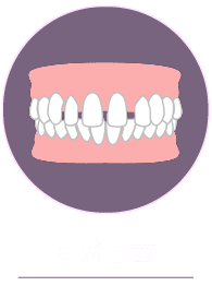 すきっ歯