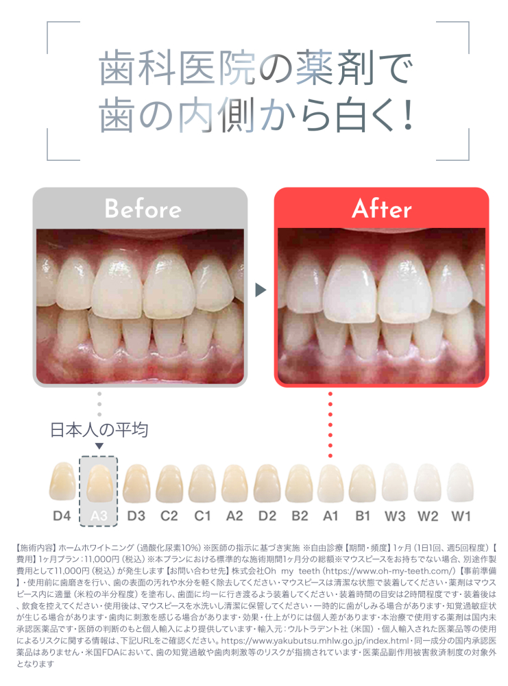 歯科医院の薬剤で歯の内側から白く